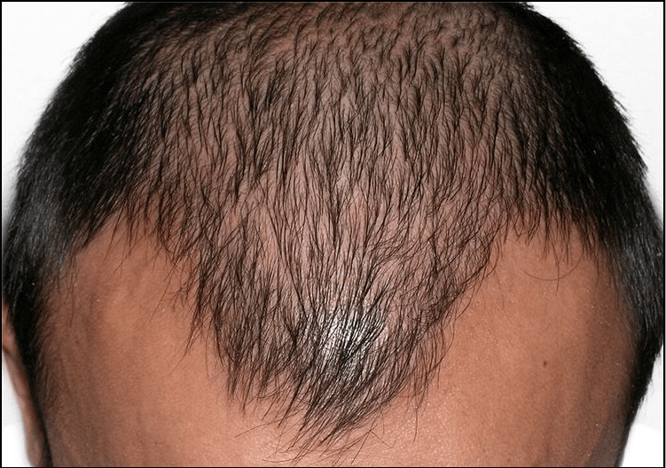 RHRLI before and after hair restoration
