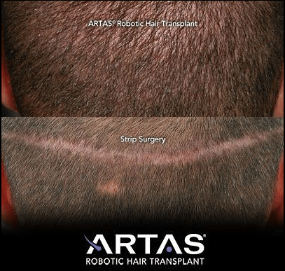 RHRLI before and after hair restoration