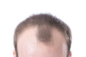 Hair Restoration for Men in Long Island, NY | RHRLI