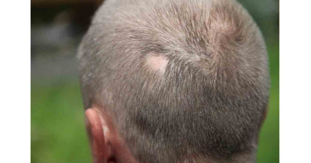 Telogen Effluvium from RHRLI