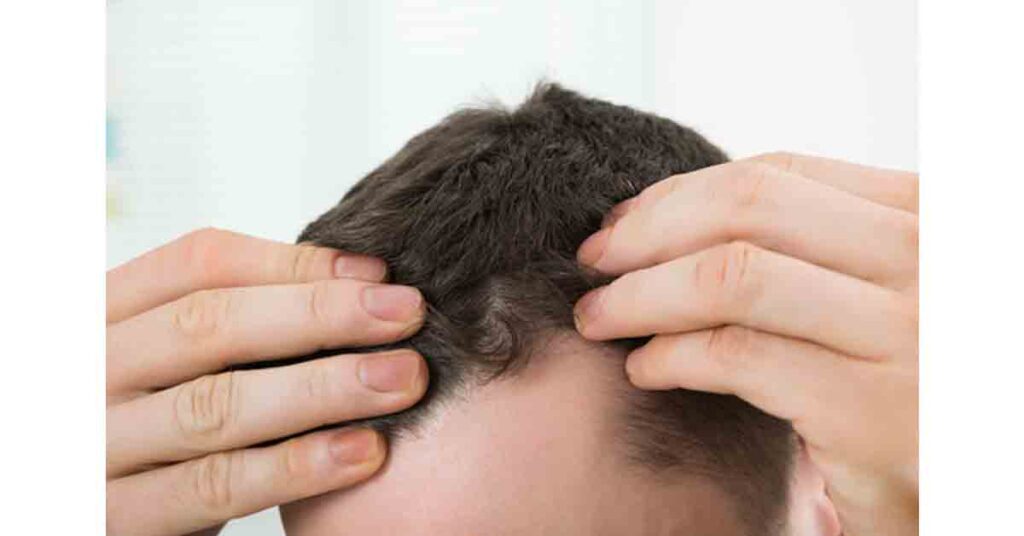 Correcting High Hairlines by RHRLI