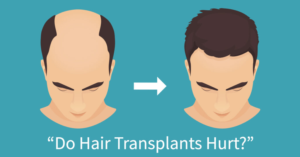Robotic Hair Restoration is minimally invasive and virtually performed with local anesthesia for patient comfort.