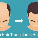 Robotic Hair Restoration is minimally invasive and virtually pain free.