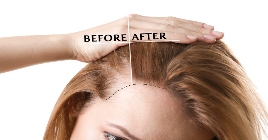 Various autoimmune diseases could be behind your thinning hair.