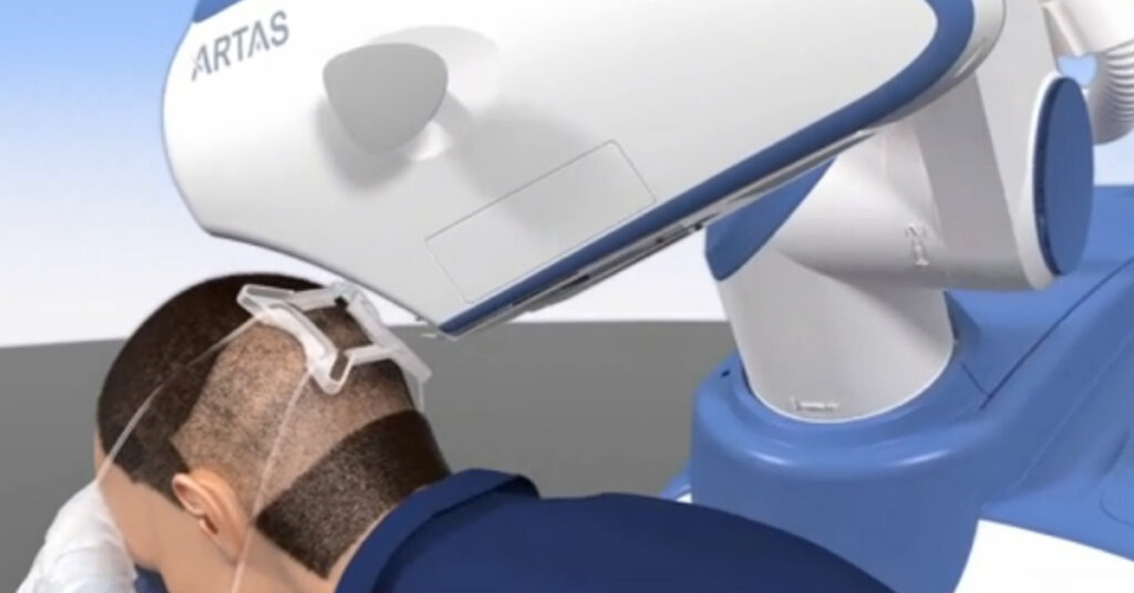 Minimally invasive robotic hair restoration