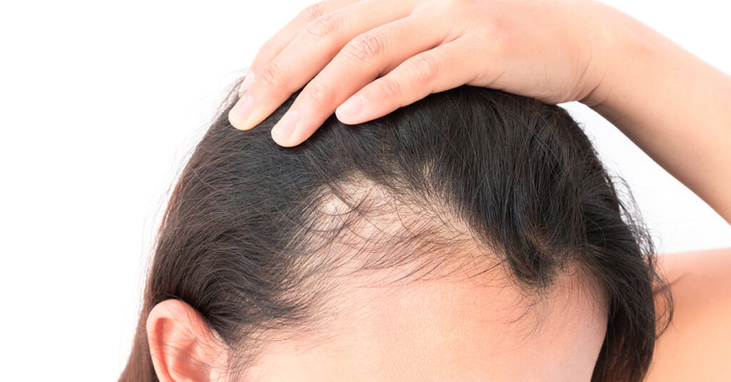 Female Pattern Hair Loss