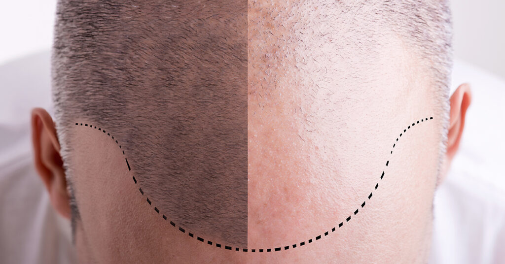 Hair restoration can be minimally invasive.