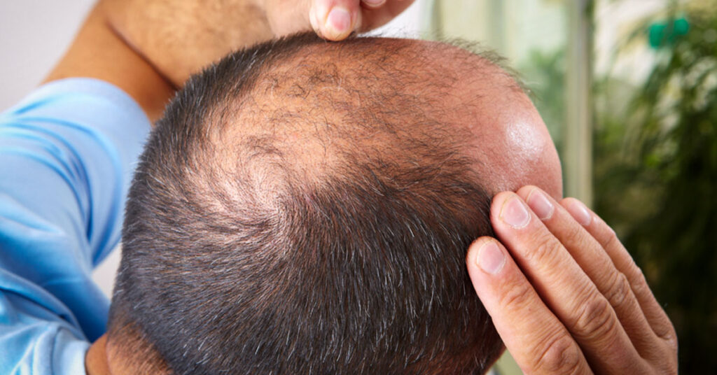 Thinning hair is more common than you'd think.