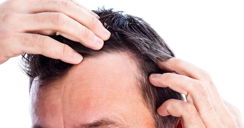Are you suffering from thinning hair?