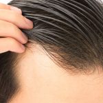 Thinning hair issues
