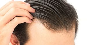 Signs of hair loss