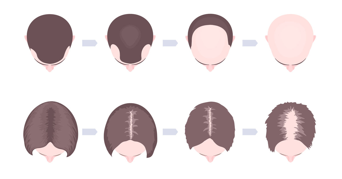 the evolution of hair loss