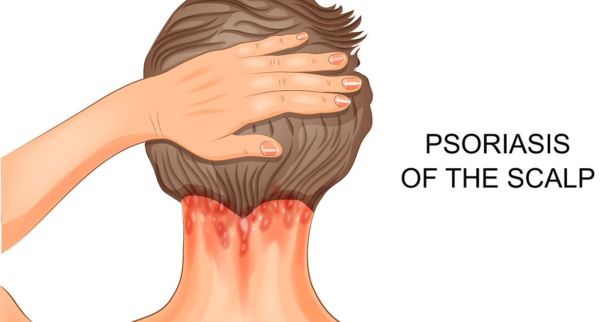 Psoriasis of The Scalp and hair loss