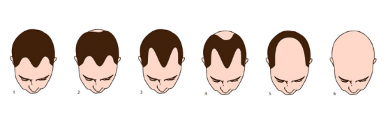 Male Pattern Hair Loss Stages