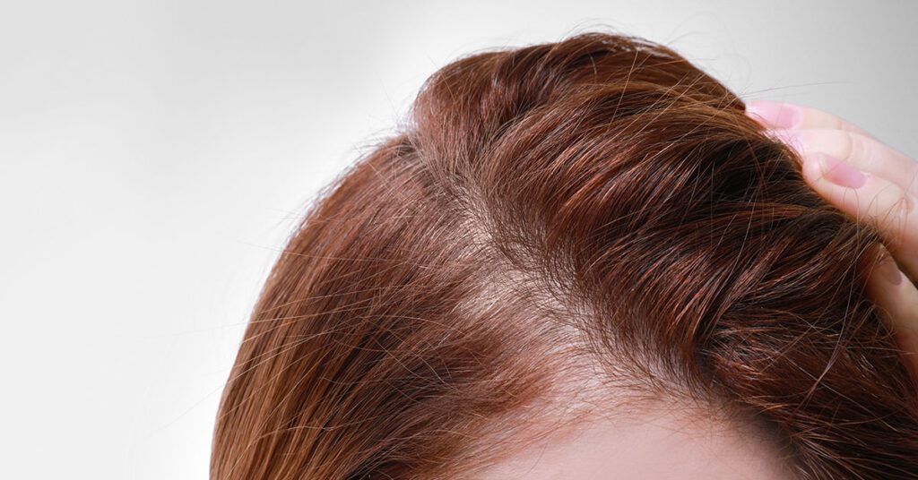 Trans Women and Hair Loss