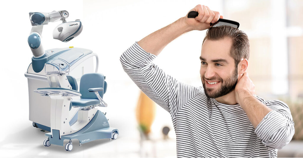 Man combing his hair 5 months after hair transplant