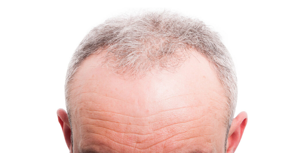 Hair Line of RHRLI Patient