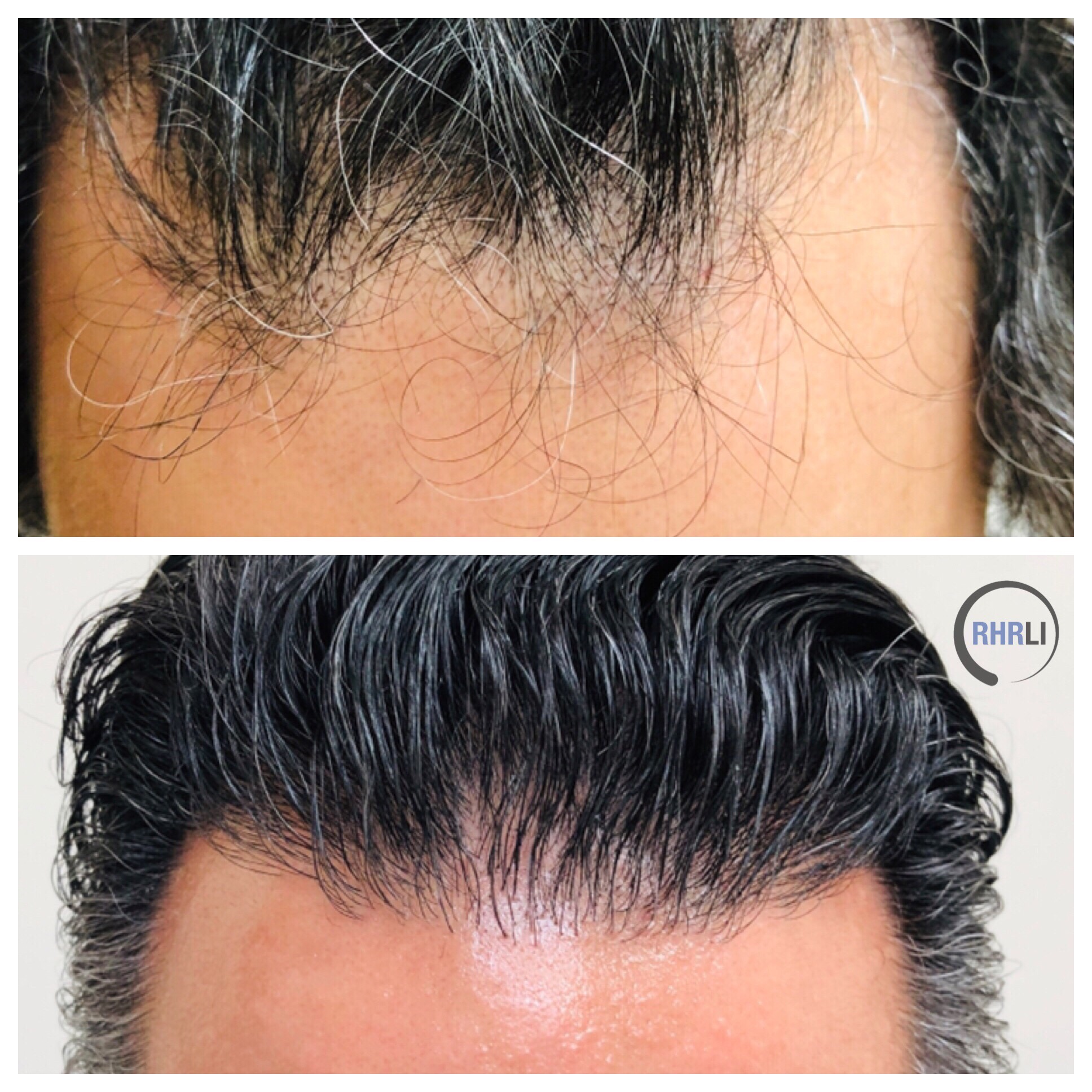 Before & After Hair Restoration Gallery | RHRLI