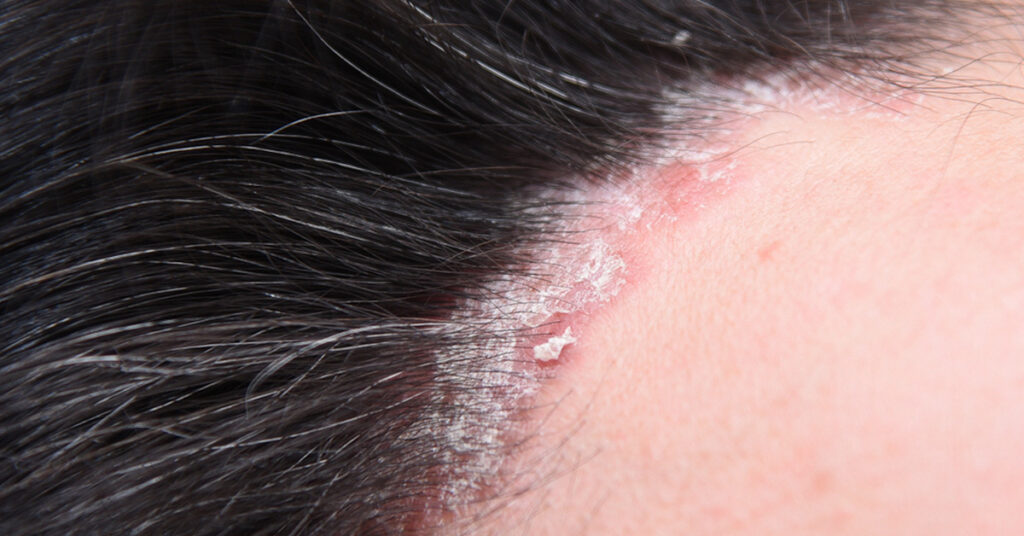 What psoriasis looks like
