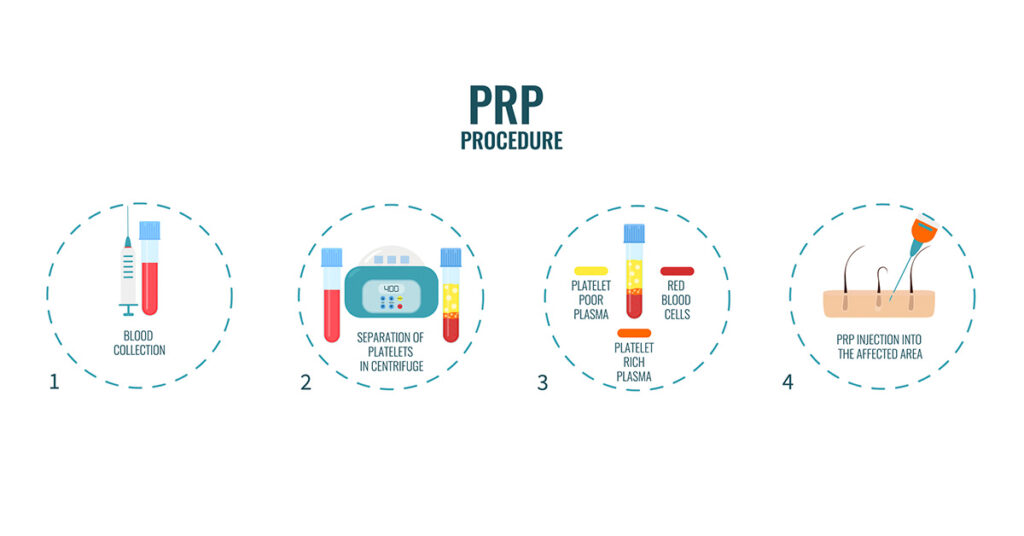 platelet rich plasma therapy infographic