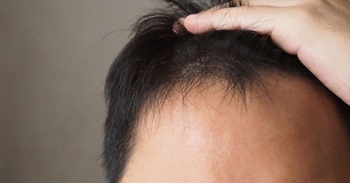 Asian hairline