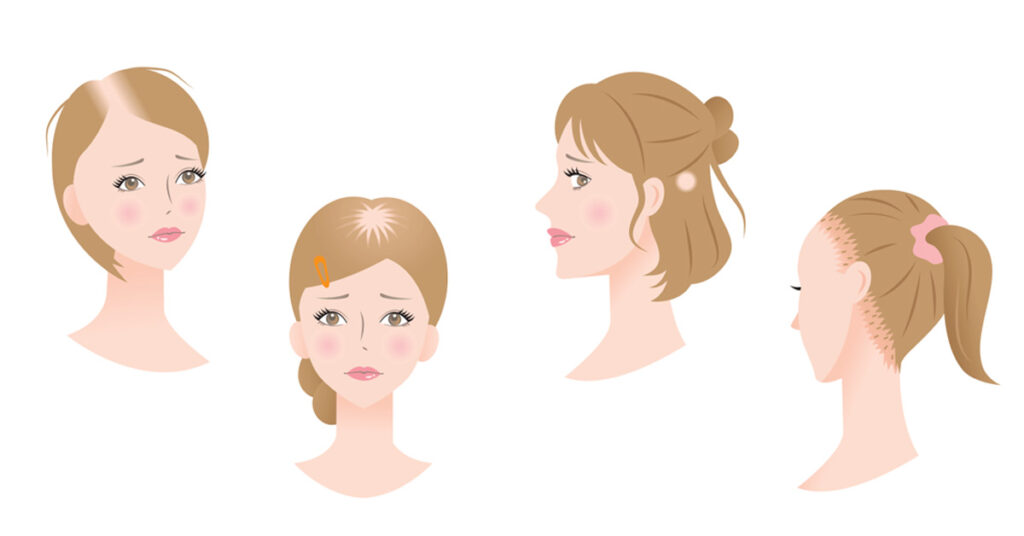 Traction Alopecia