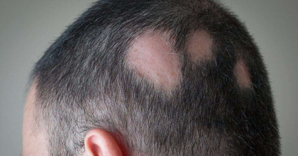 Autoimmune disease caused hair loss