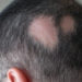 Autoimmune disease caused hair loss