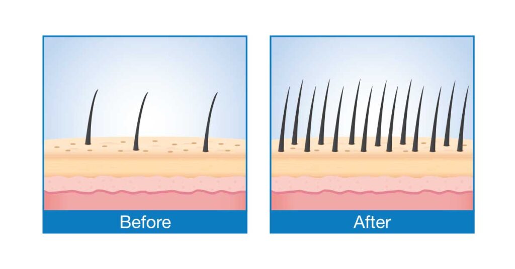 Donor Hair Before and After