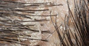 Scalp Eczema Causing Hair Loss