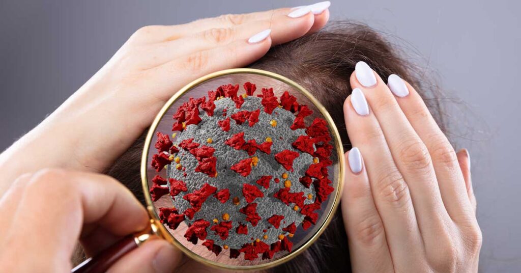 COVID-19 and Hair Loss