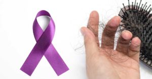 lupus and hair loss