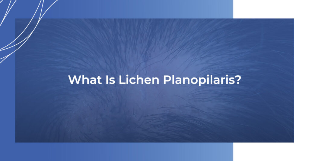What is Lichen Planopilaris?