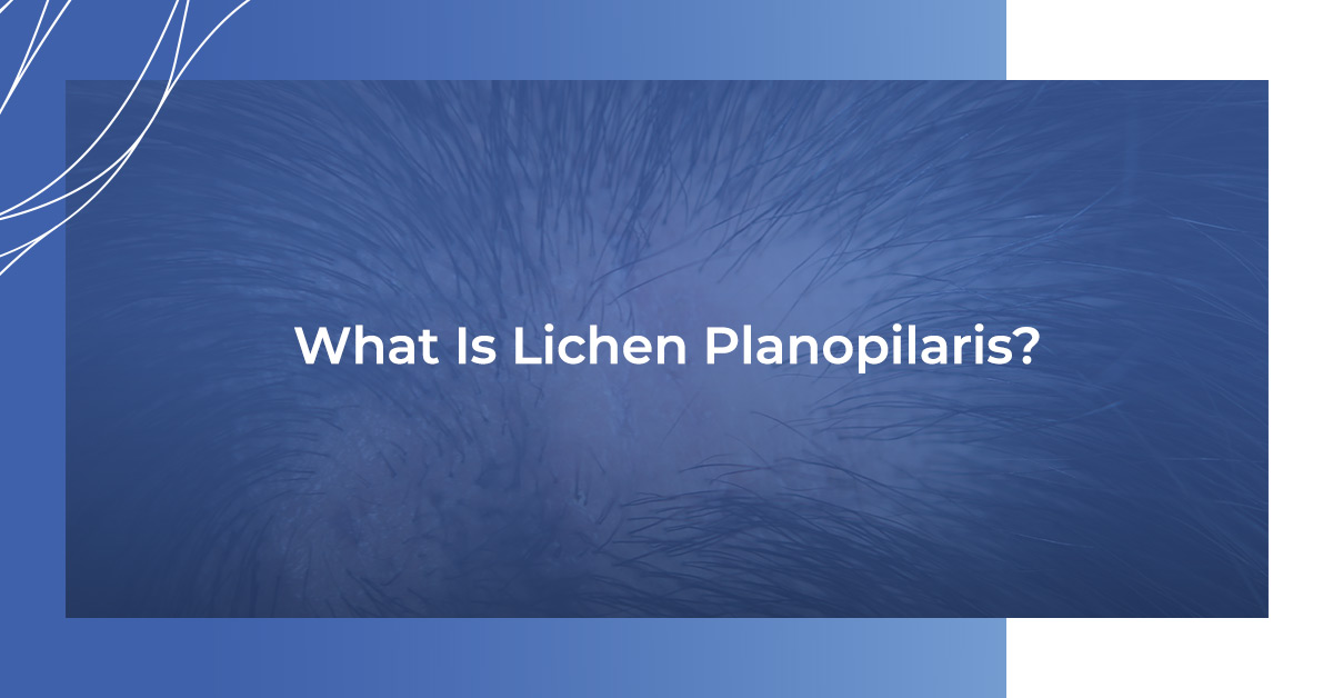 What is Lichen Planopilaris?