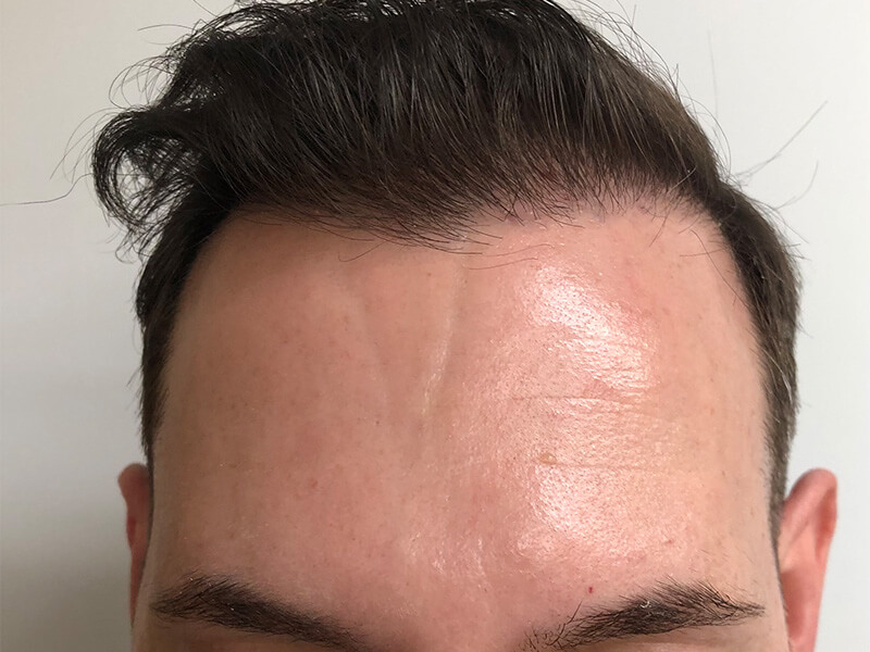 Receding Hairline In Pune 2ajay chauhan 3000 fue-min – Hair Transplant Pune