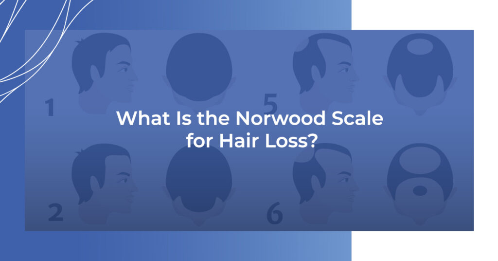 What is the Norwood Scale for hair loss?