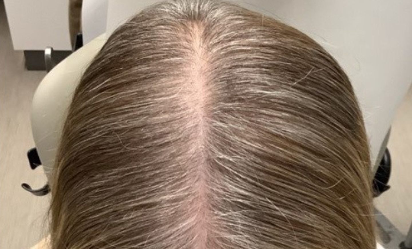 Before Alma TED Procedure