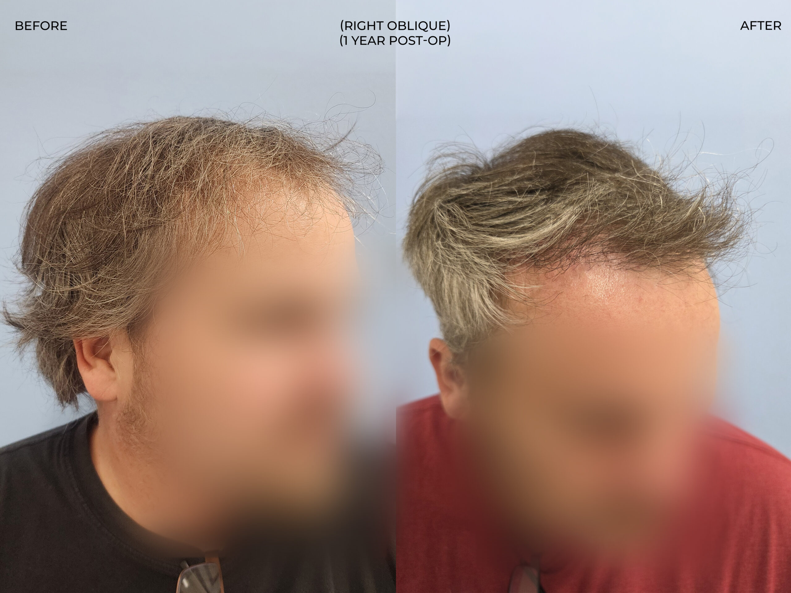 Right oblique view before and after FUT (strip), 3,381 grafts, 53 year old man
