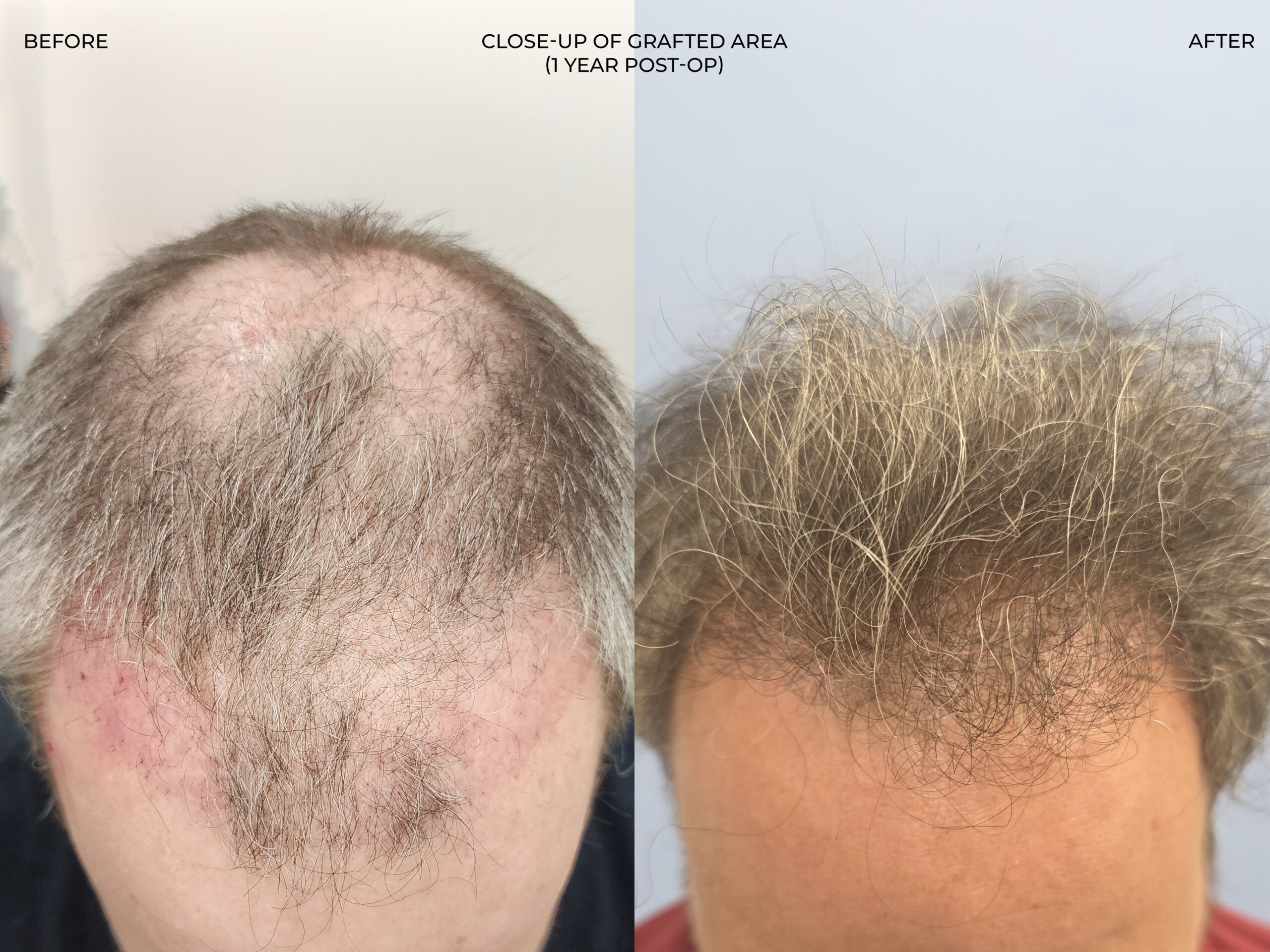 Top-down view before and after FUT (strip), 3,381 grafts, 53 year old man