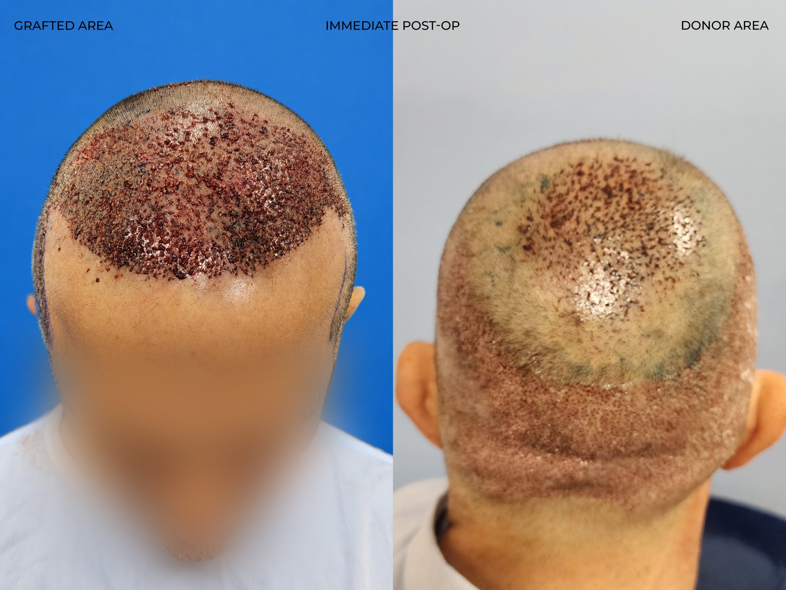 Hairline close-up view before and after FUE — ARTAS iXi robot + NeoGraft, 4,142 grafts, 59 year old man