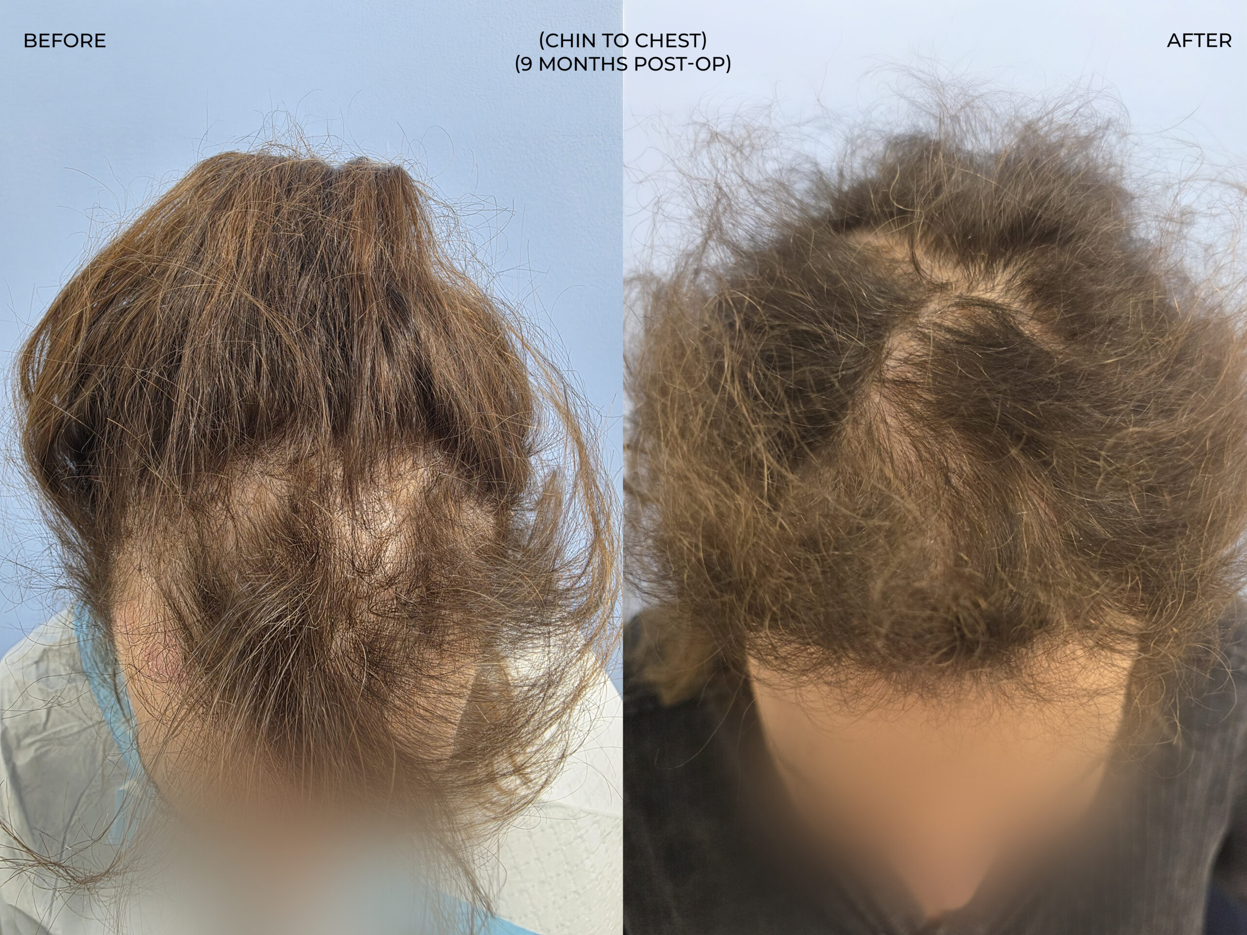 Chin to chest view before and after FUT (strip), 3,510 grafts, 73 year old woman