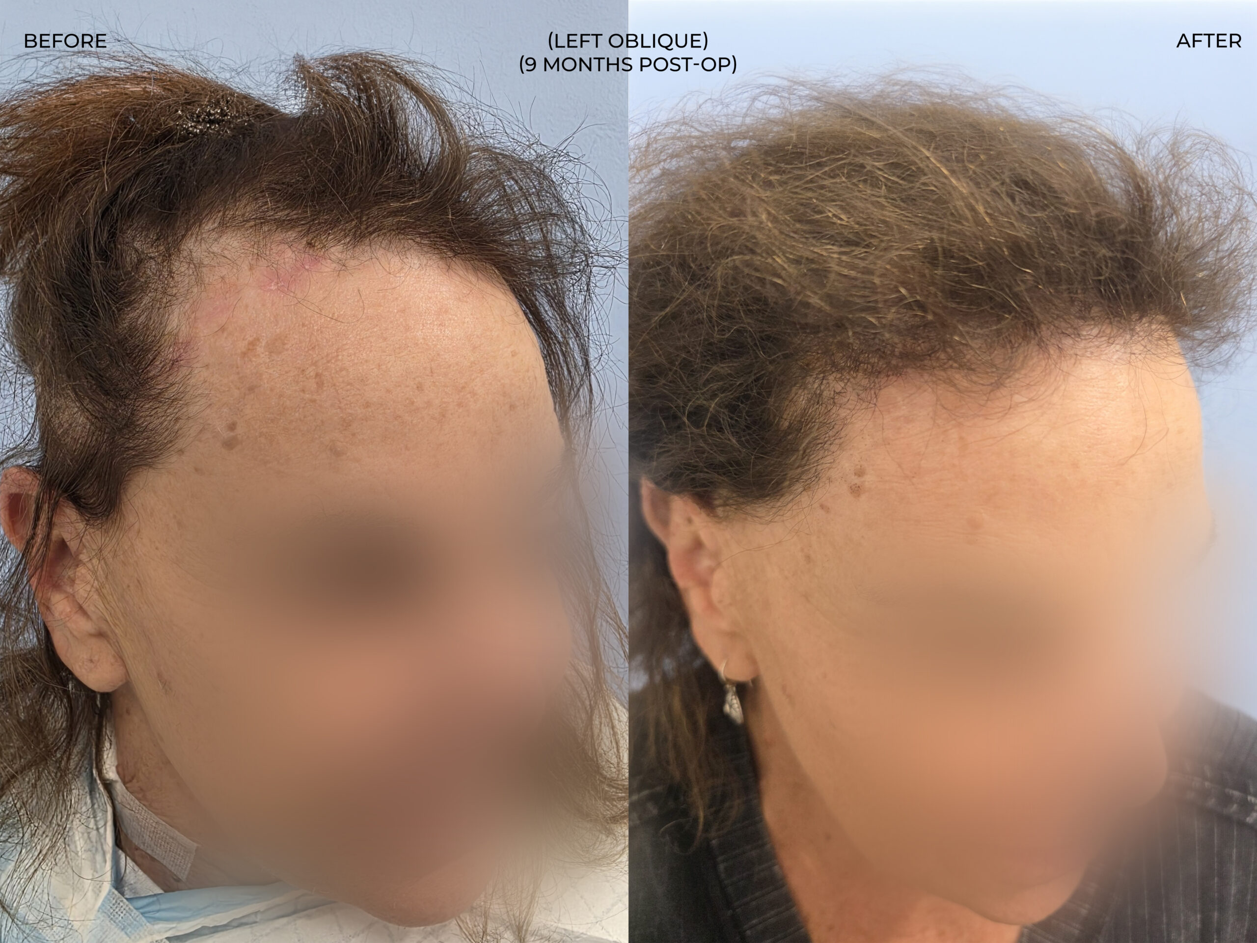 Left oblique view before and after FUT (strip), 3,510 grafts, 73 year old woman