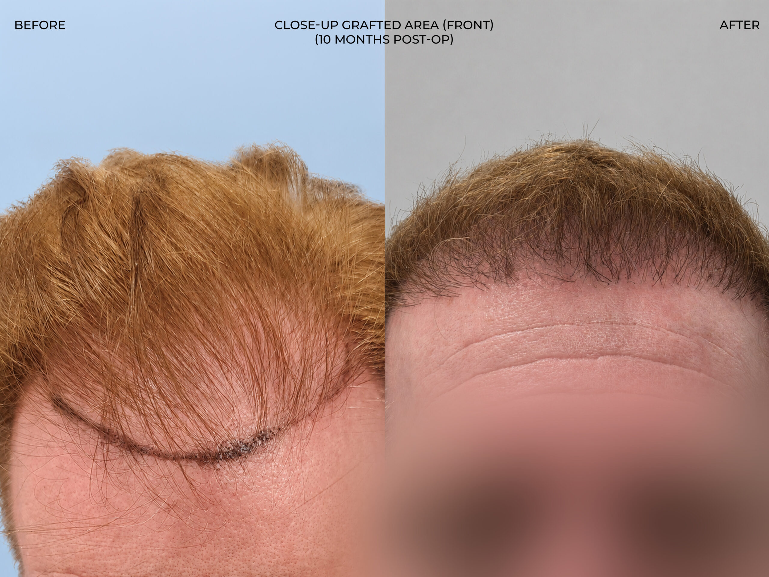 Top-down view before and after FUT (strip), 3,300 grafts, 57 year old man