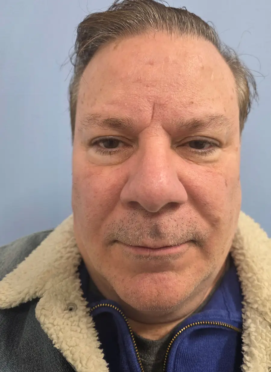 After hair transplant — 2,458 grafts · 62 y/o man