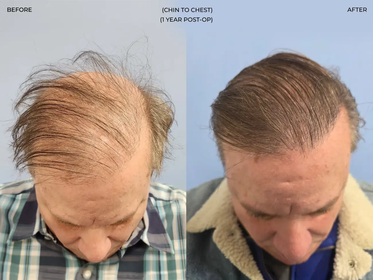 Chin to chest view before and after FUE (NeoGraft), 2,458 grafts, 62 year old man