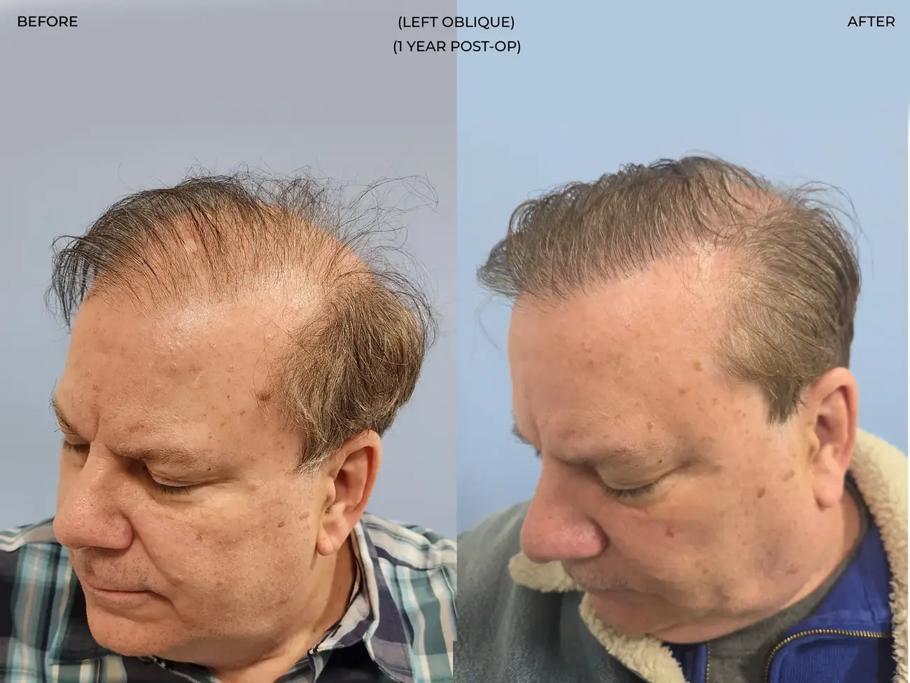 Left oblique view before and after FUE (NeoGraft), 2,458 grafts, 62 year old man