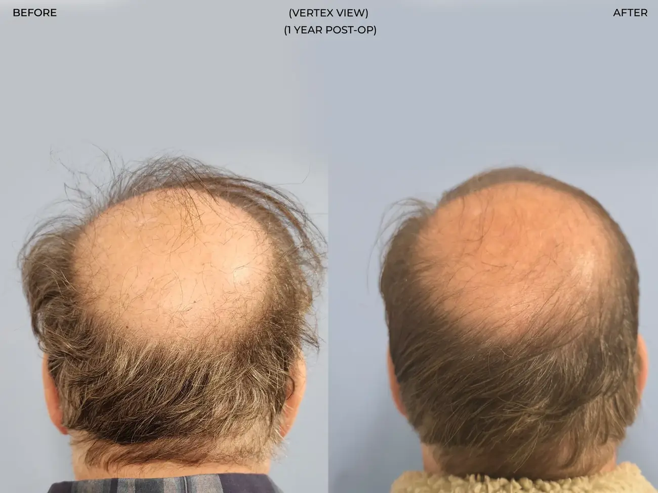 Vertex (crown) view before and after FUE (NeoGraft), 2,458 grafts, 62 year old man