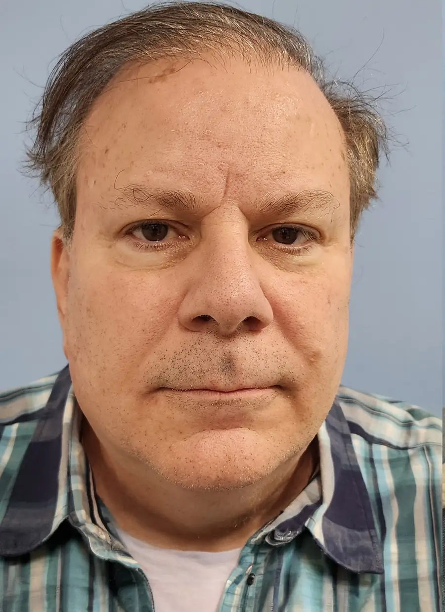 Before hair transplant — 2,458 grafts · 62 y/o man