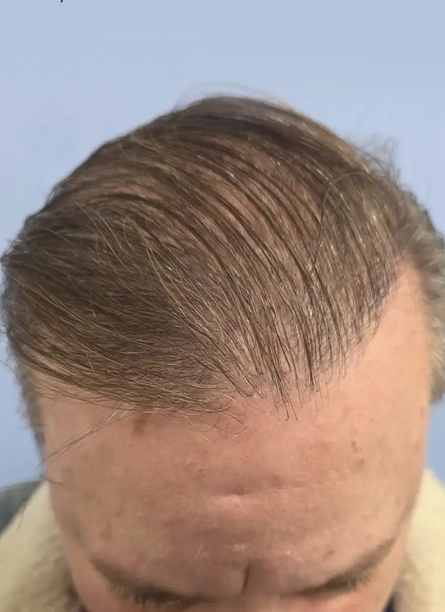 After NeoGraft FUE, 2,458 grafts