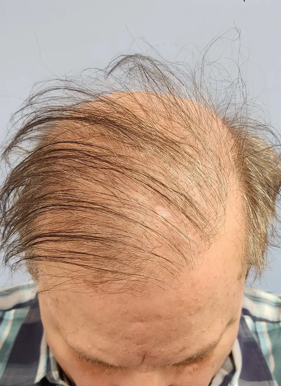 Before NeoGraft FUE, 2,458 grafts